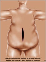 open_weight_loss_surgery-bmc-THUMB